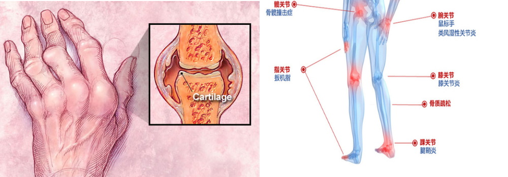關節(jié)疼痛？骨痛？是不是得了類風濕性關節(jié)炎？