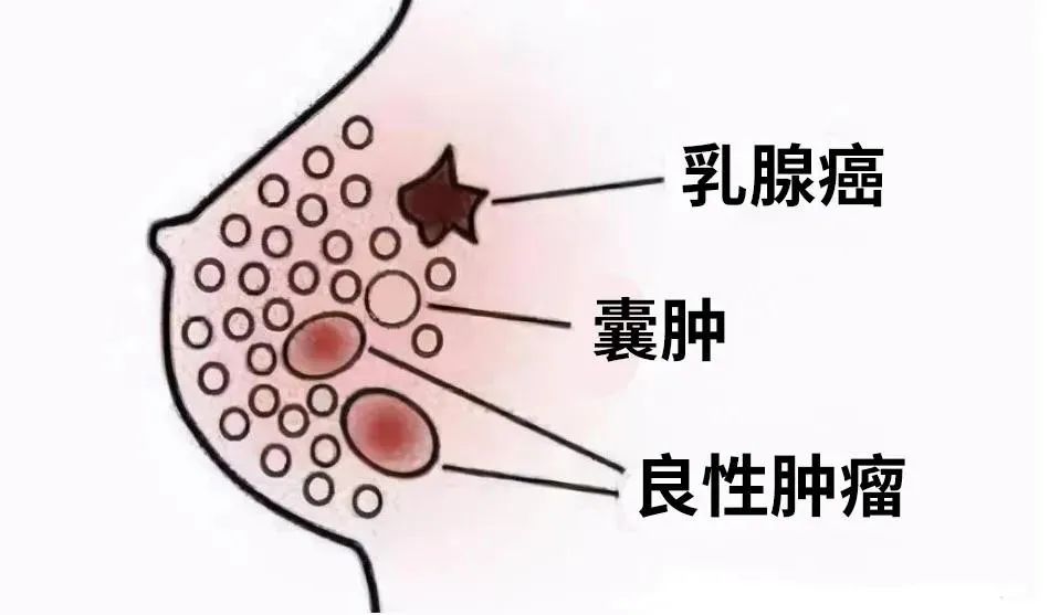 惡性乳腺結(jié)節(jié)長什么樣？形態(tài)、邊緣、縱橫比有這些特點！